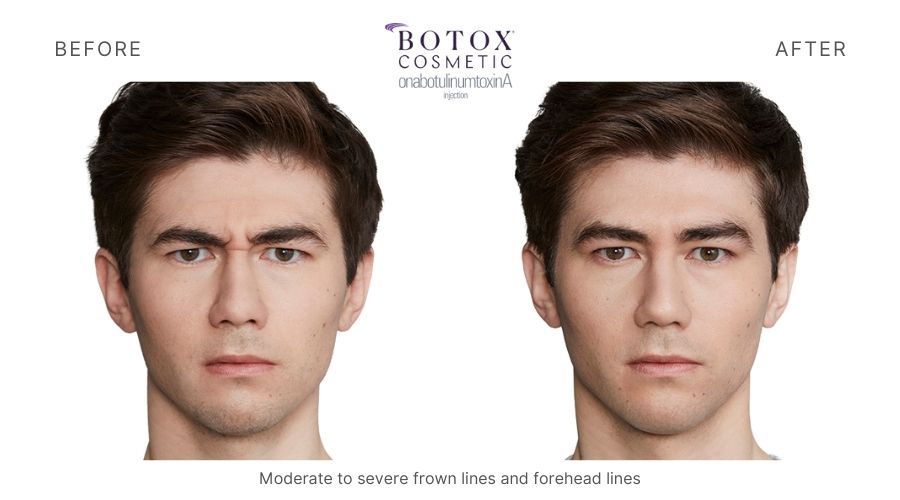 Man's forehead showing Botox Before and After results. Haus of Aesthetics.