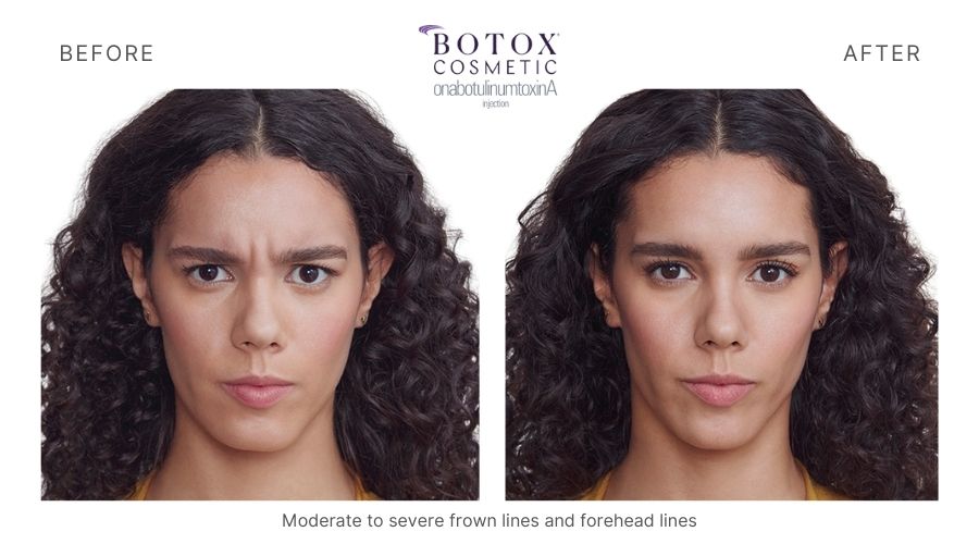 Woman with beautiful results adding a youthful appearance with Botox, results show Before and After. Haus of Aesthetics.