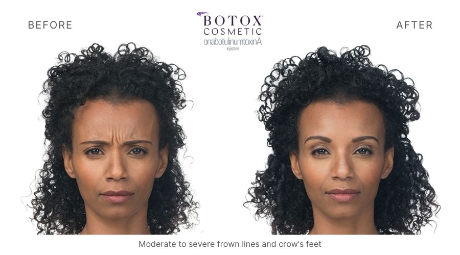 Woman's Botox Before and After results showing a relaxed expression. Treatment at Haus of Aesthetics.