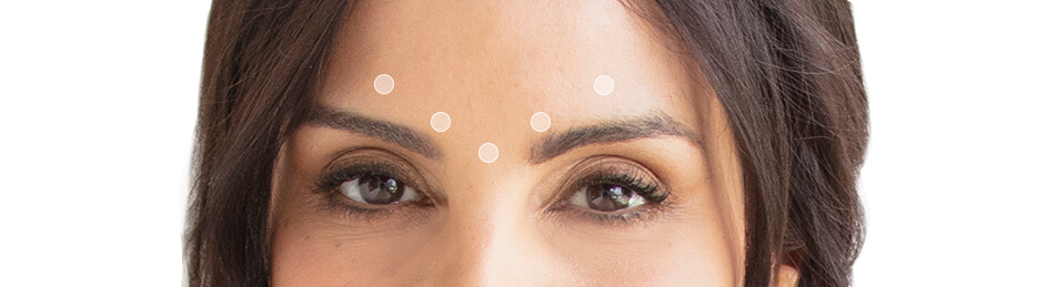 Woman's forehead modeling the dysport injection treatment areas to smooth forehead and wrinkle lines.