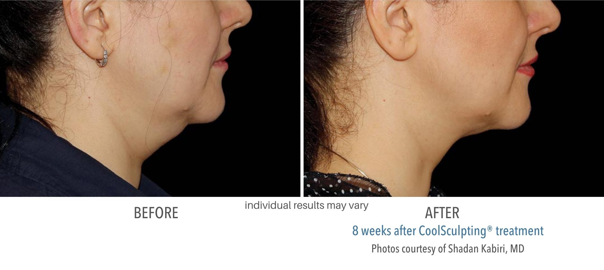 Woman's jowls before and after Coolsculpting. Treatment at Haus of Aesthetics.