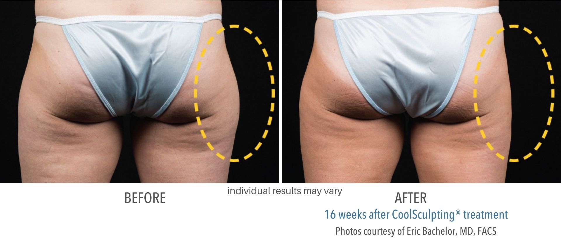 Thighs before and after coolsculpting treatment results.