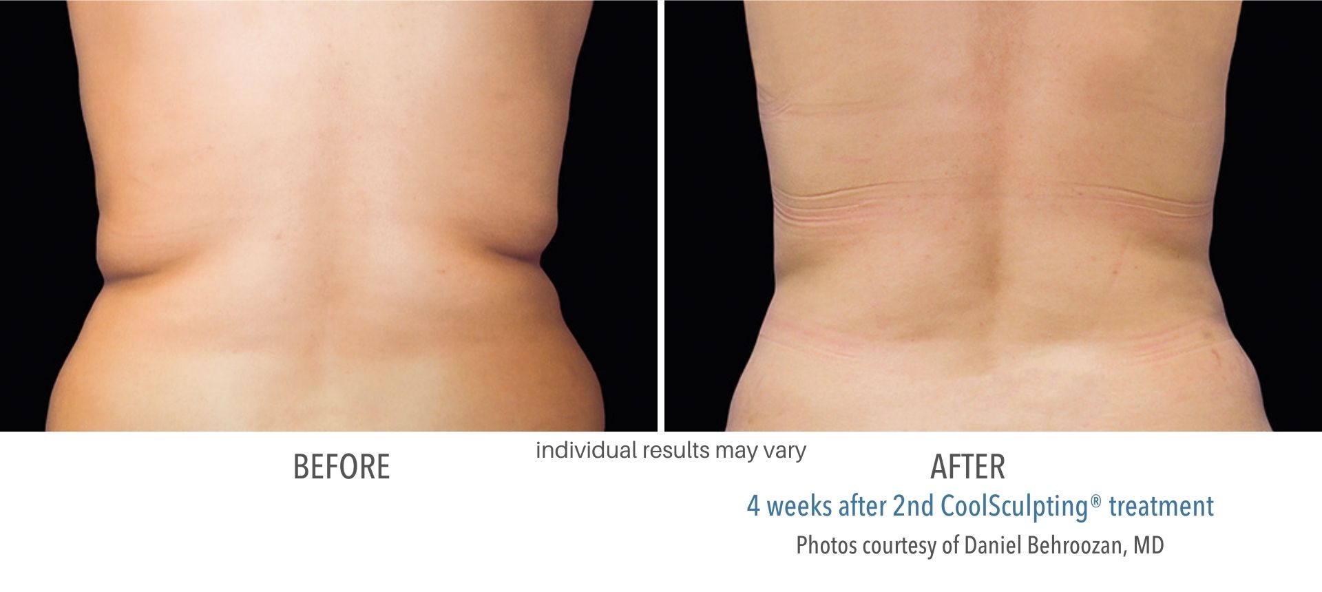 Back flanks showing before and after results from CoolSculpting fat freezing treatment at Haus of Aesthetics.