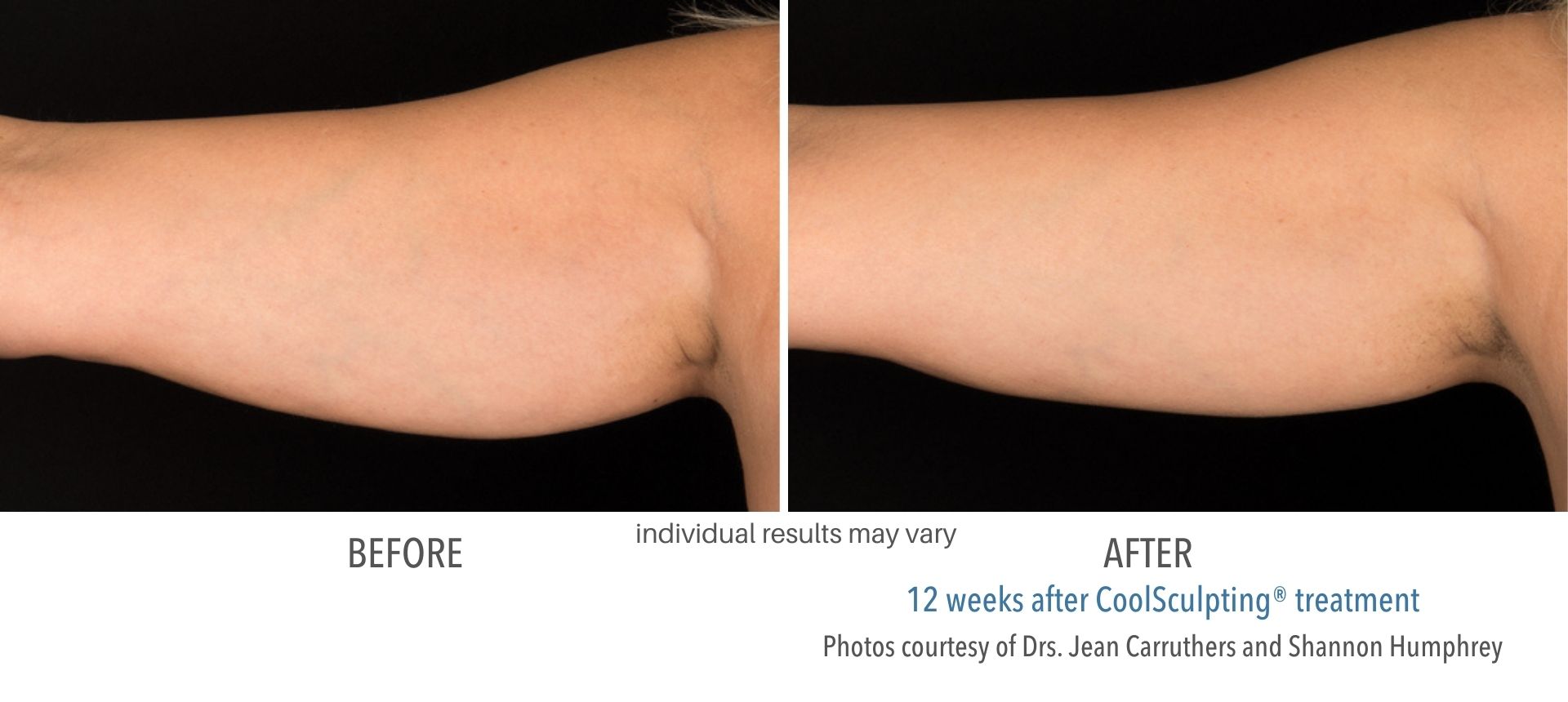 Under arms showing before and after results from CoolSculpting treatment in Salt Lake City, Utah.