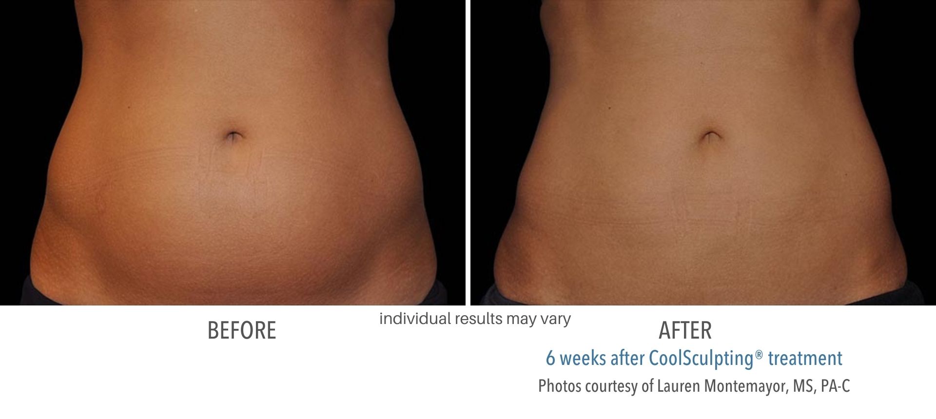 Absomen before and after CoolSculpting treatment at Haus of Aesthetics.