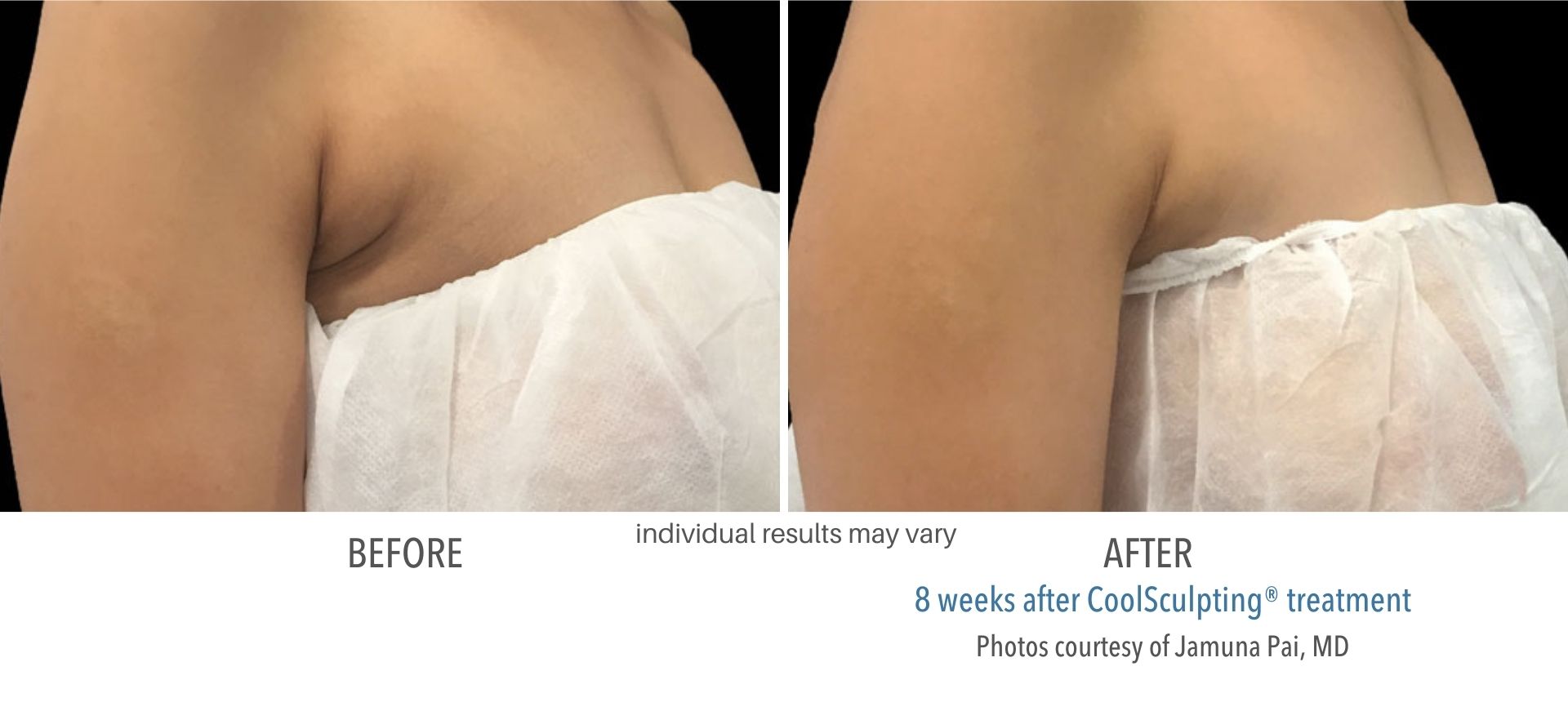 Armpit fat reduction before and after CoolSculpting treatment in Salt Lake City, Utah.
