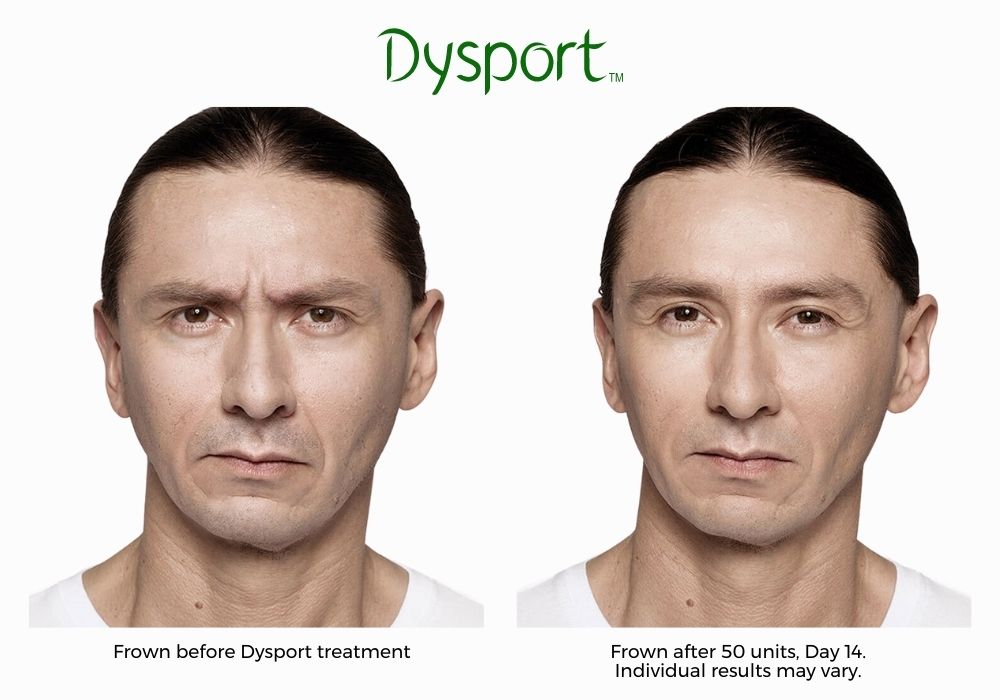 Man's face before and after dysport injectable treatment at Haus of Aesthetics.
