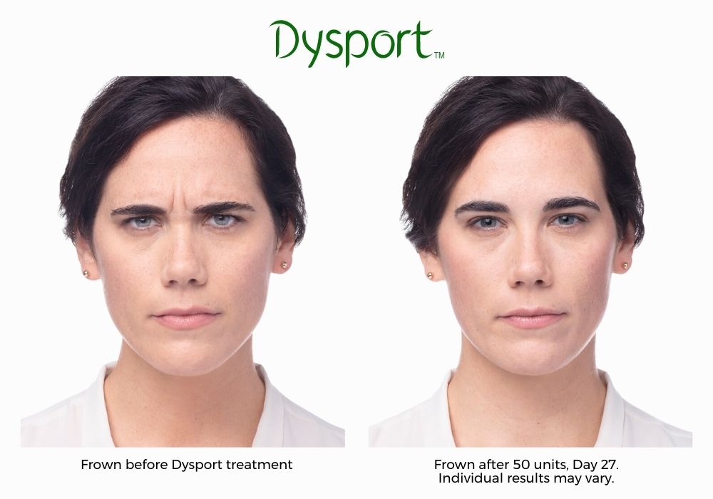 Woman with brown hair shows relaxed and smoothed forehead before and after Dysport. Treatment available at Haus of Aesthetics.