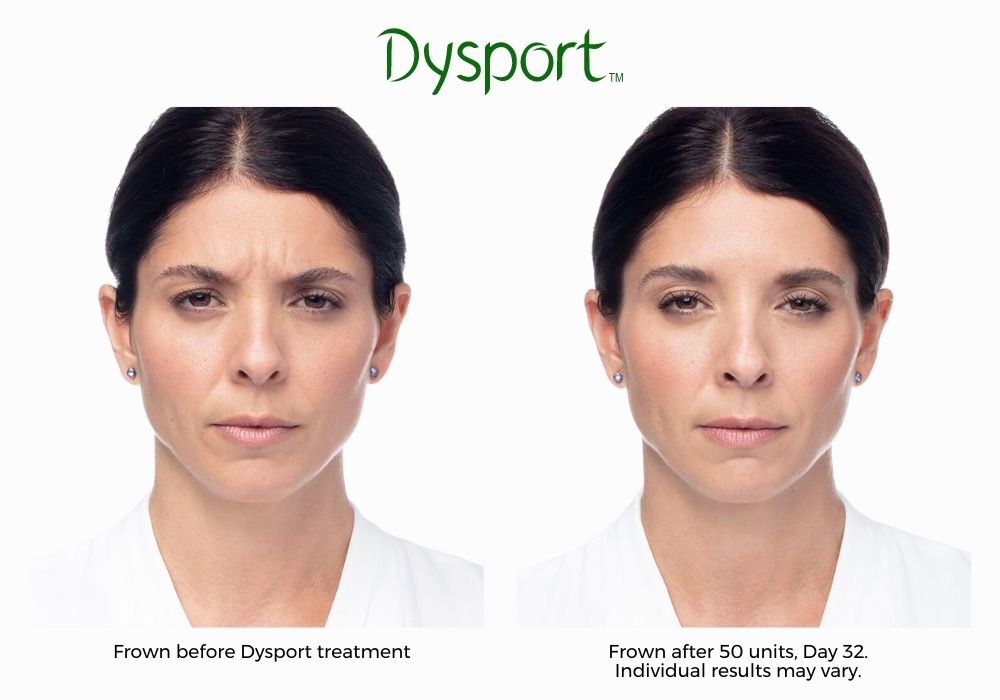 Dysport before and after results, Haus of Aesthetics.