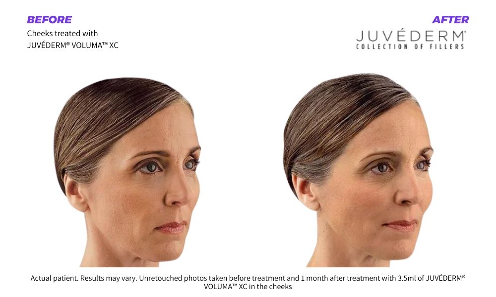 Woman's before and after Juvederm results.