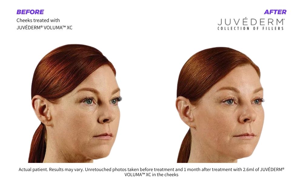 Woman's beautiful before and after results from Juvederm. Haus of Aesthetics.