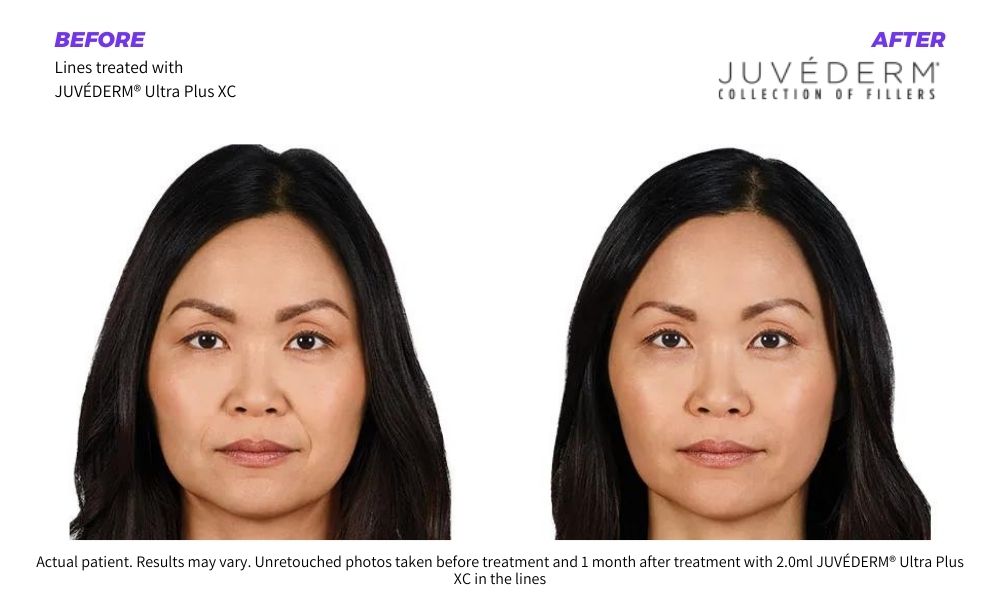Woman's before and after Juvederm results with beautifully enhanced features.