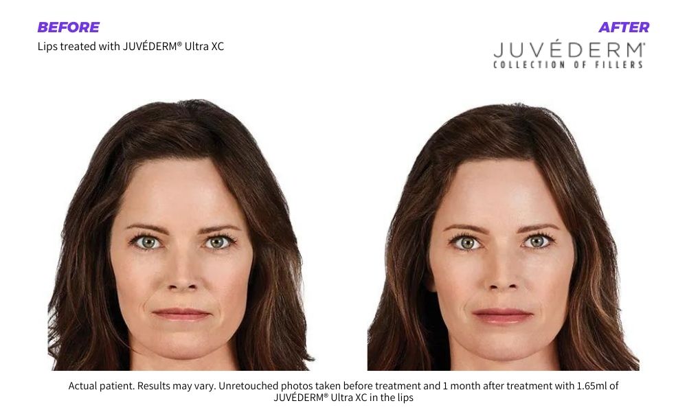 Haus of Aesthetics - Juvederm - Woman's amazing before and after results.