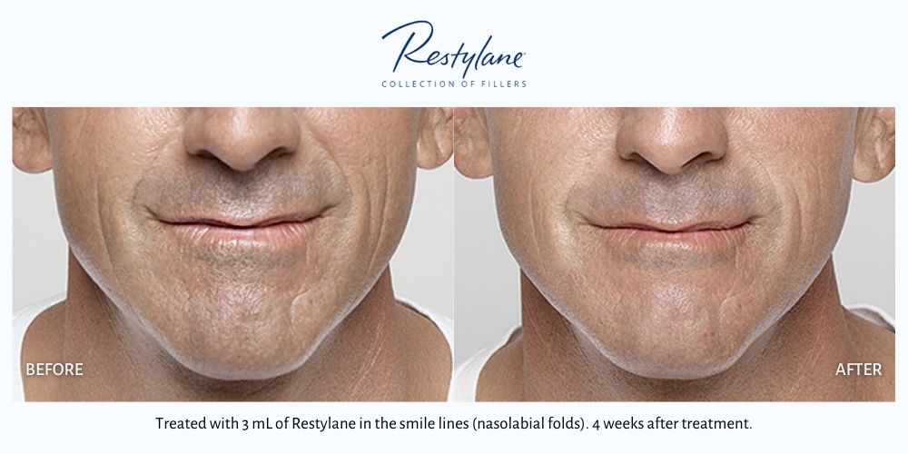 Mans mouth before and after restylane. Haus of Aesthetics.