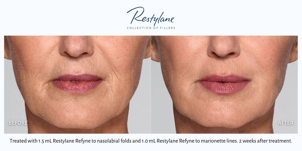 Woman's before and after results from restylane treatment at Haus of Aesthetics.