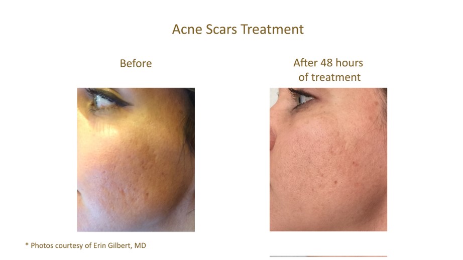 Incredible before and after results from Aquagold treating Acne in SLC.