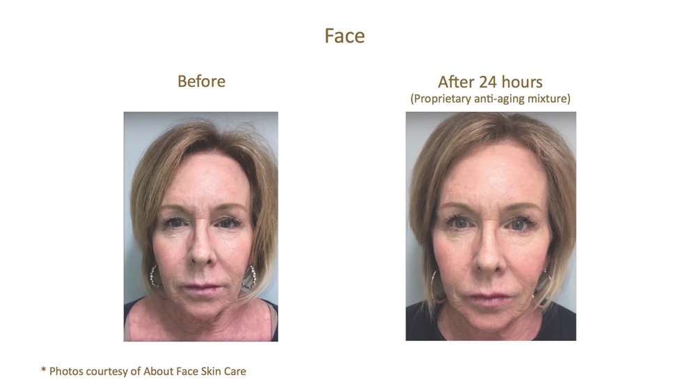 Woman's before and after treatment results with Aquagold Anti aging treatment in Salt Lake City.