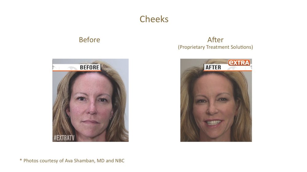 Before and after Aquagold treatment showing improved skin tone on the cheeks.