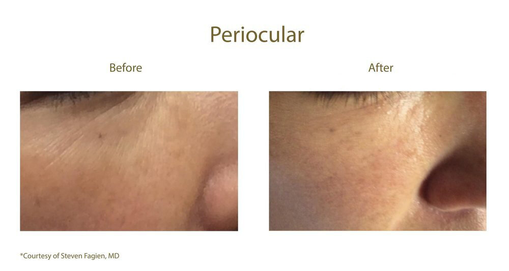 Before and after aquagold fine touch periocular treatment in Salt Lake City.