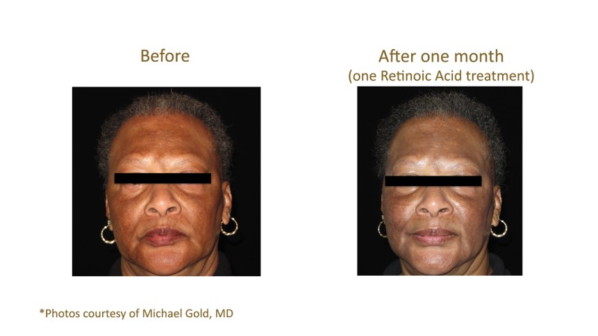 Woman's amazing results showing before and after aquagold treatment.
