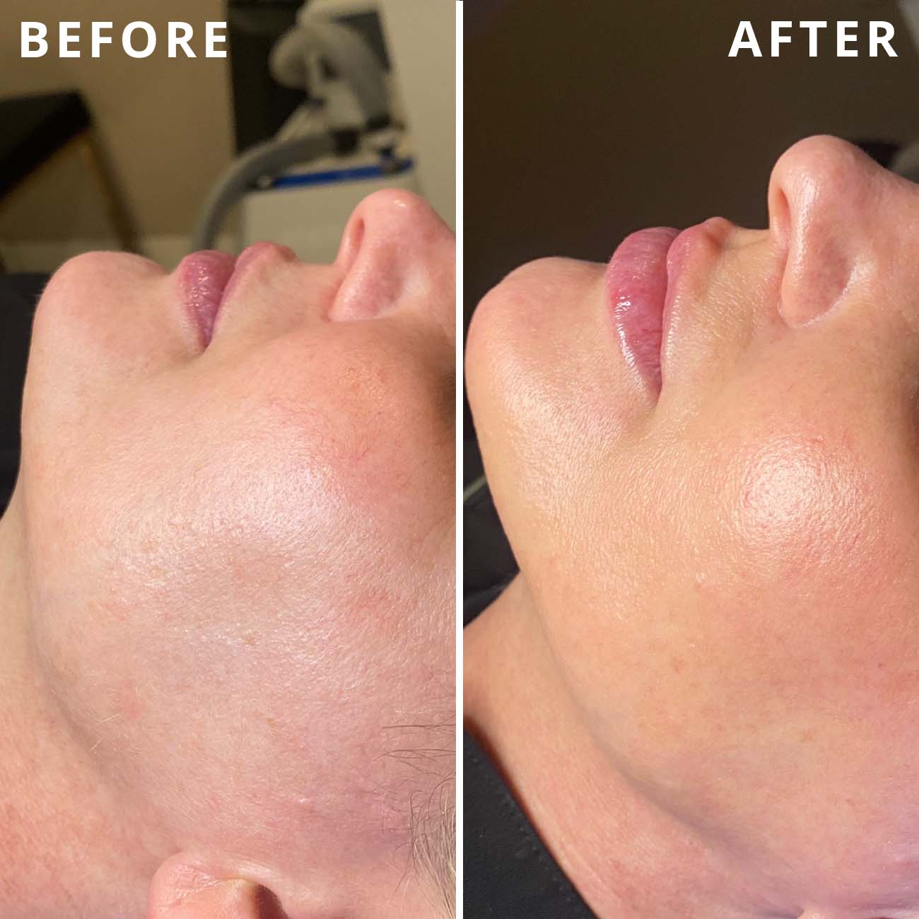 Woman's face before and after hydrafacial in SLC.