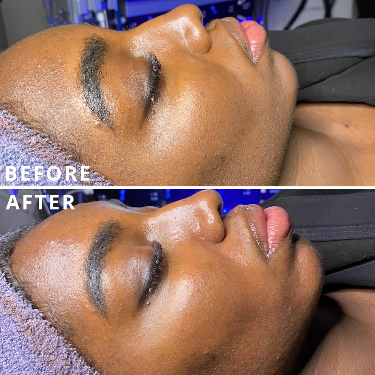 Ethnic woman with amazing before and after hydrafacial to her face by Haus of Aesthetics.