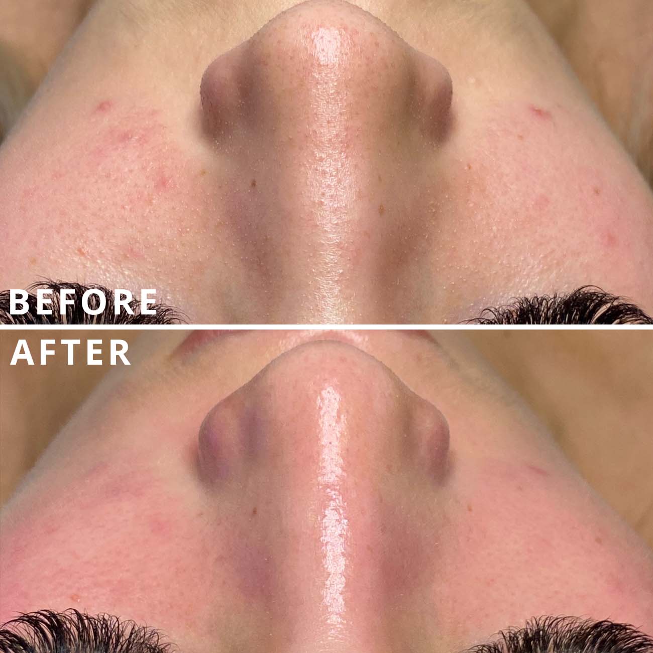 Womans nose and cheeks showing amazing before and after results from hydrafacial, skin looking clear and glowing.