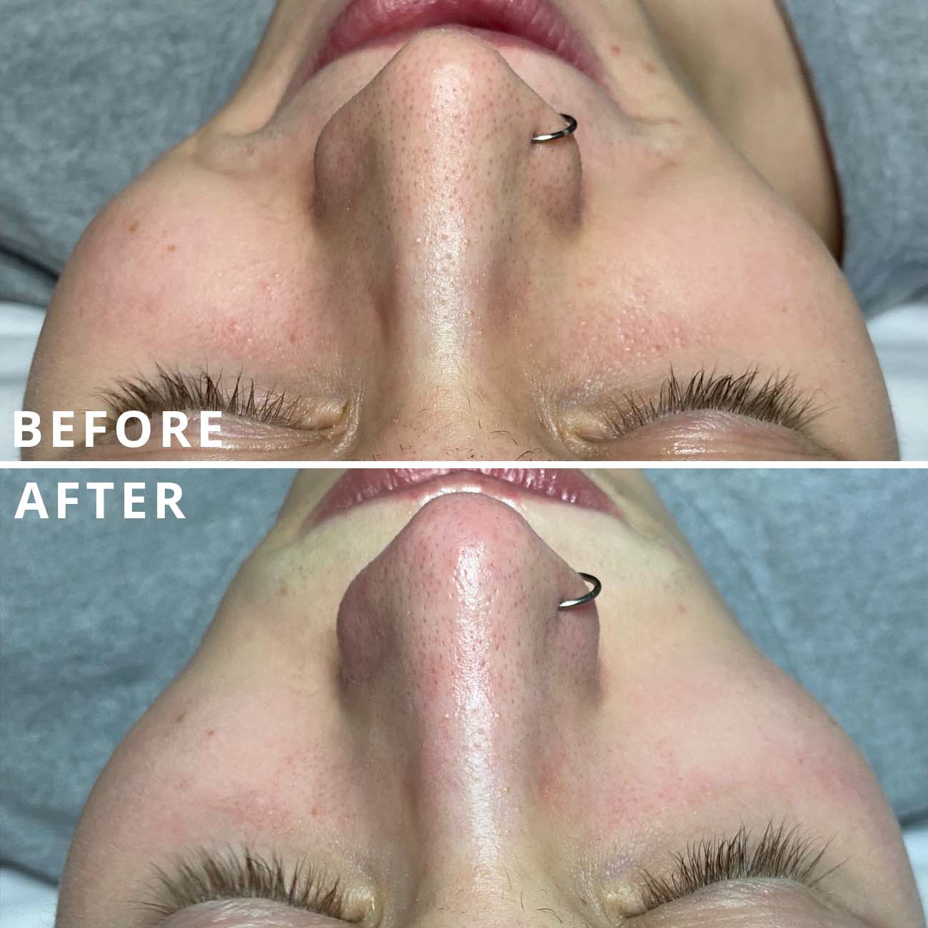 Before and after hydrafacial treatment.