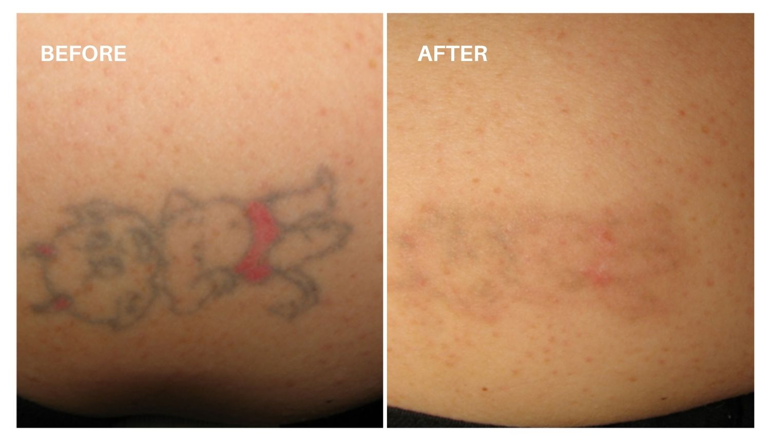 Laser Tattoo Removal in Salt Lake City at Haus of Aesthetics