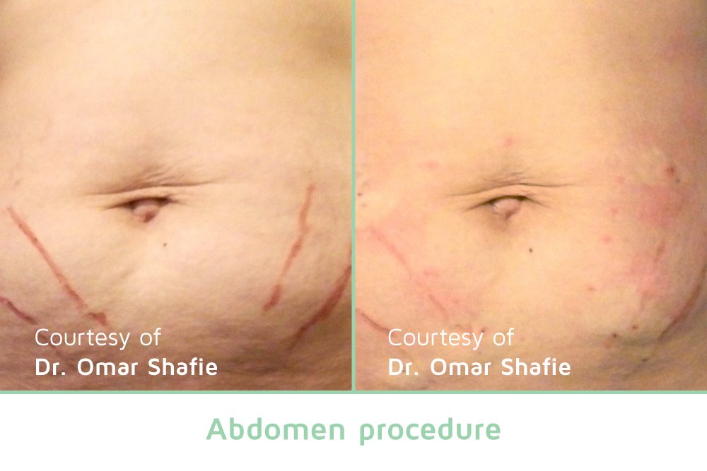 Abdomen showing before and after Nova PDO threads lift.