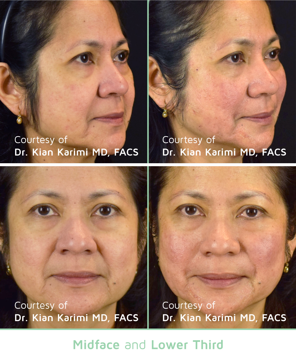 Woman's face showing incredible before and after PDO Threads lift treatment at Haus of Aesthetics.