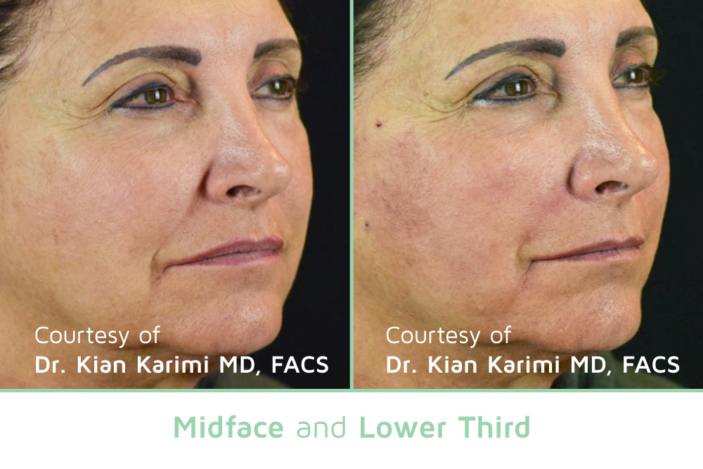 Mature woman with incredible results after PDO threads done by the experts at Haus of Aesthetics.