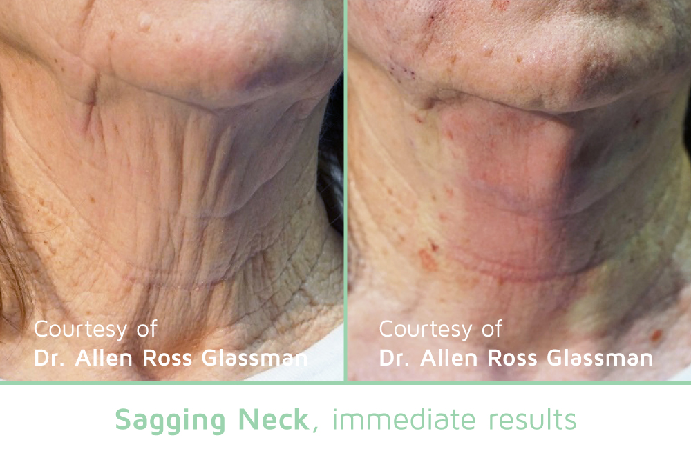 Neck area before and after Nova PDO threads to tighten and firm the skin.
