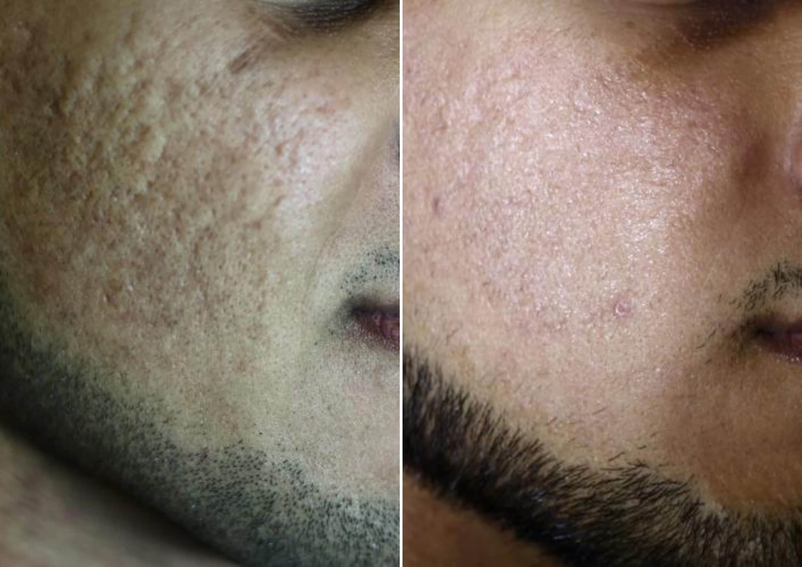 Before and after results of improved skin complexion with CO2RE Laser Resurfacing treatment in Salt Lake City.