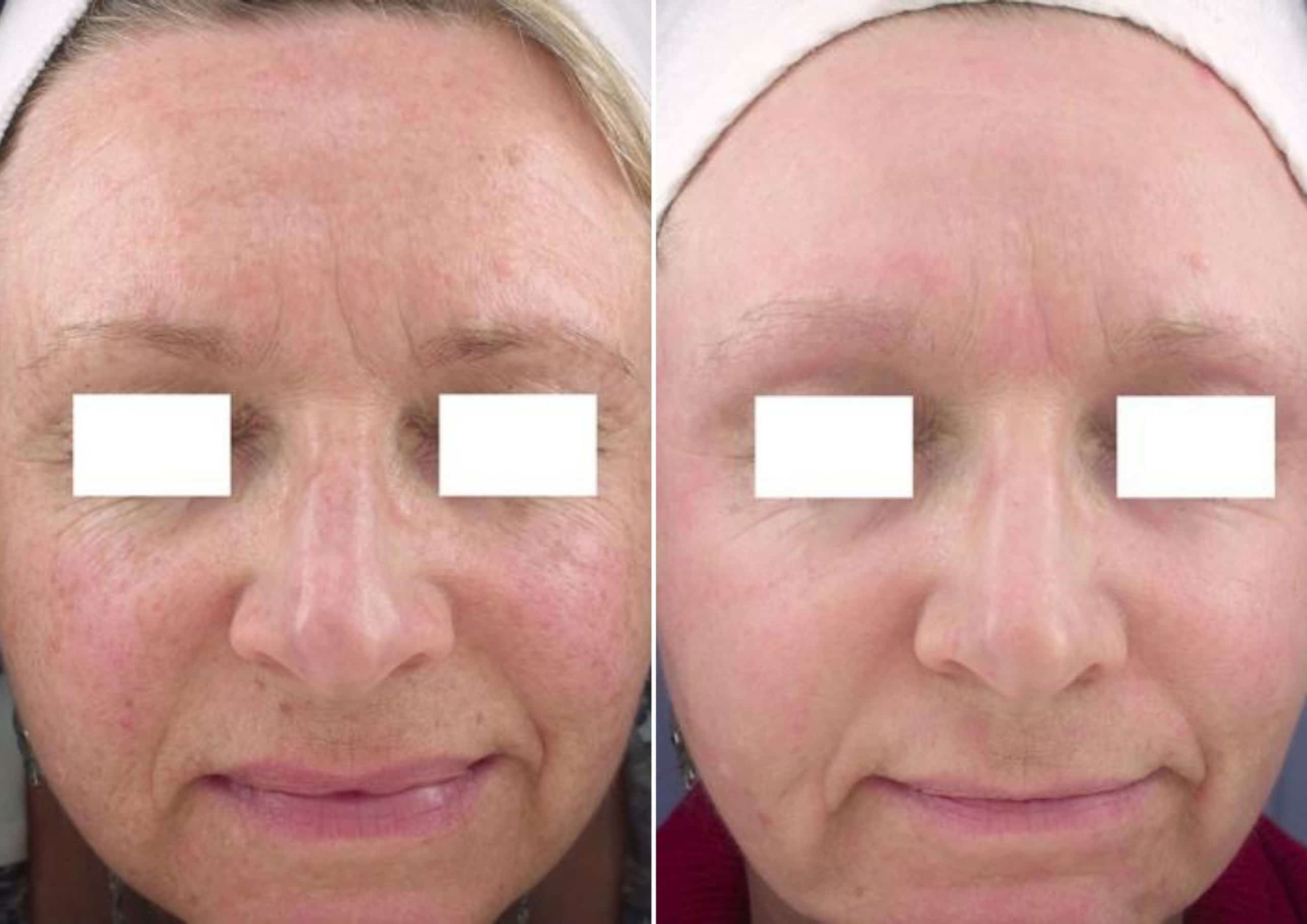 Before and after results of improved skin complexion with CO2RE Laser Resurfacing treatment in Salt Lake City.