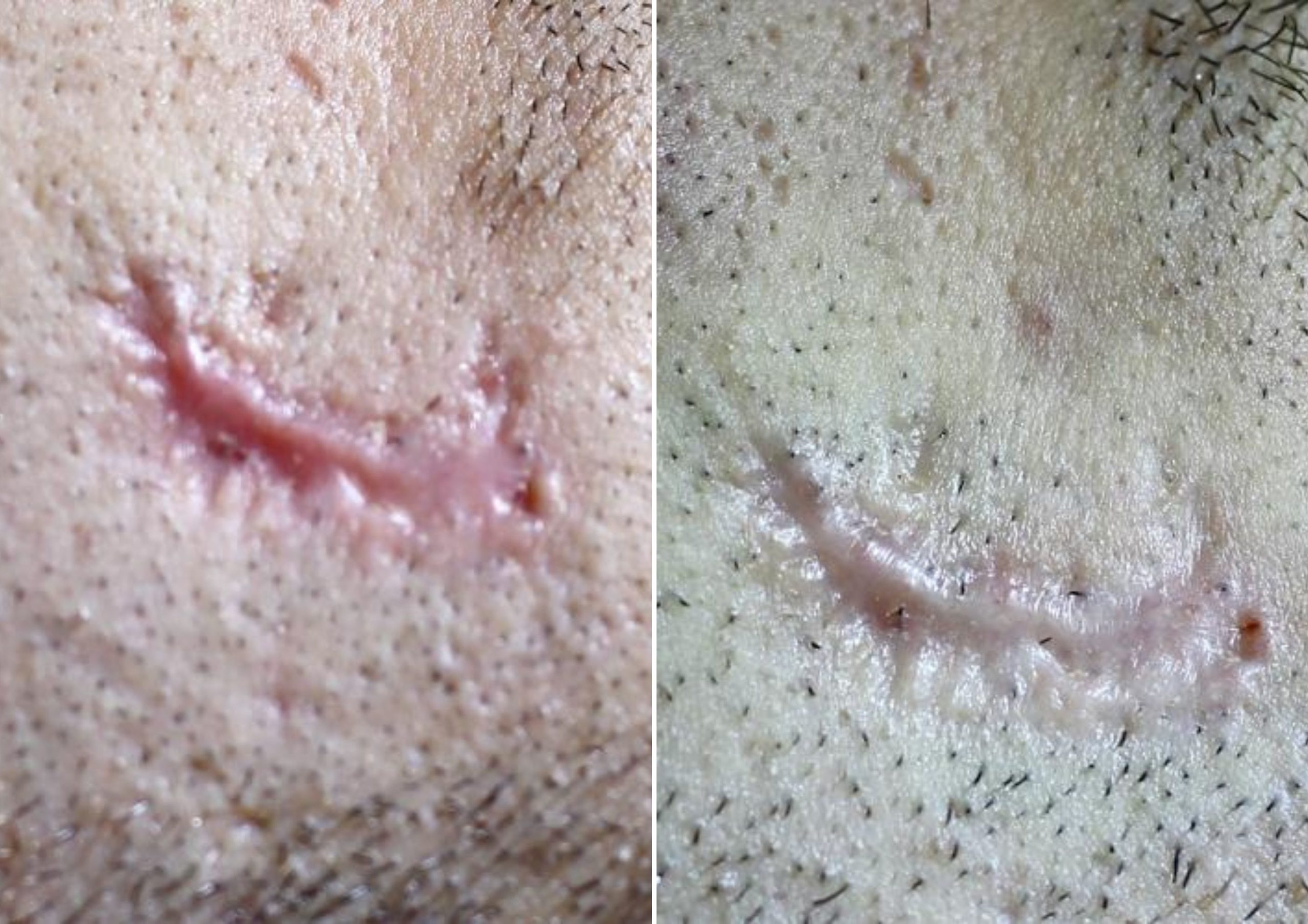 Before and after results of improved scarring with CO2RE Laser Resurfacing treatment in Salt Lake City.