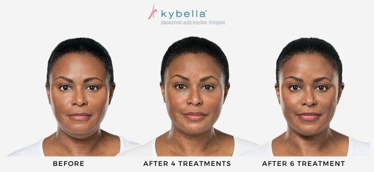 Woman's before and after Kybella non-surgical treatment for submental fat reduction.