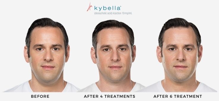 Man's before and after Kybella non-surgical treatment for submental fat reduction.