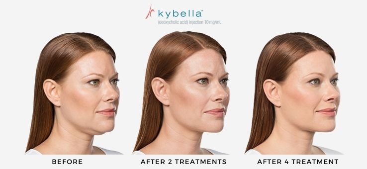 Woman's before and after Kybella non-surgical treatment for submental fat reduction.