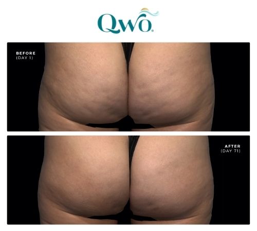 Buttocks before are after qwo injectable cellulite treatment in SLC.
