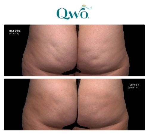 Buttocks before are after qwo injectable cellulite treatment in SLC.