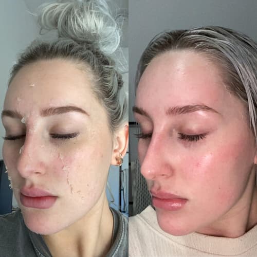 Womans before and after results from chemical peels treatment at Haus of Aesthetics showing a more rejuvenated appearance.