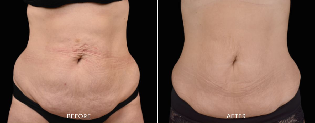 CoolSculpting Elite before and after - haus of aesthetics (1)