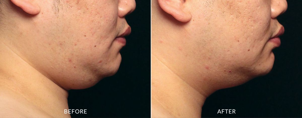 CoolSculpting Elite before and after - haus of aesthetics (2)