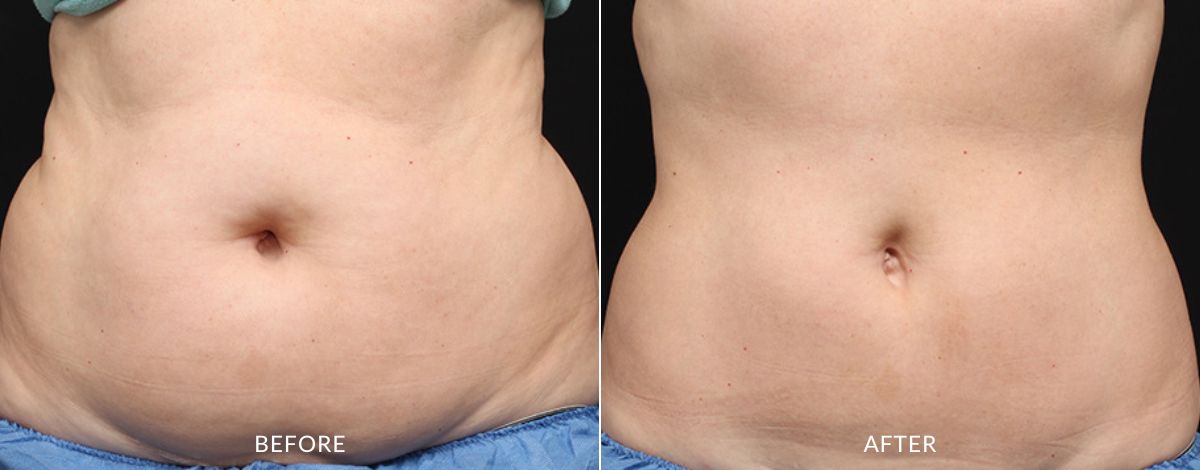 CoolSculpting Elite before and after - haus of aesthetics (4)