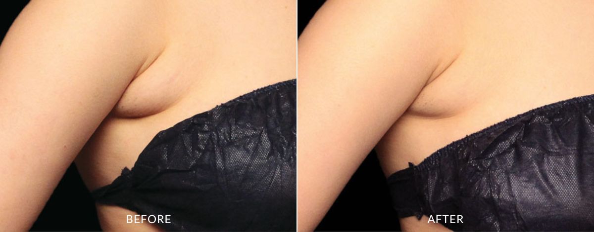 CoolSculpting Elite before and after - haus of aesthetics (5)