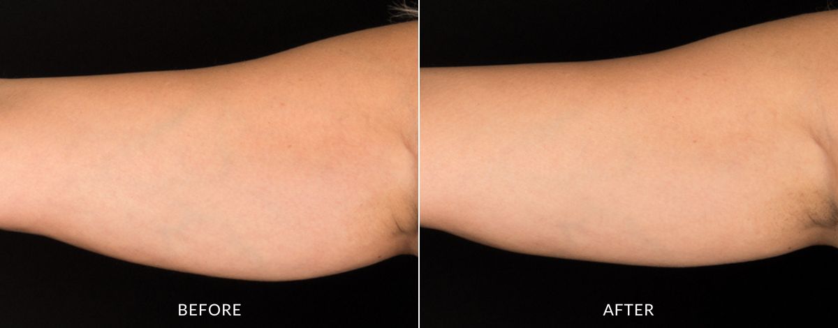 CoolSculpting Elite before and after - haus of aesthetics (6)