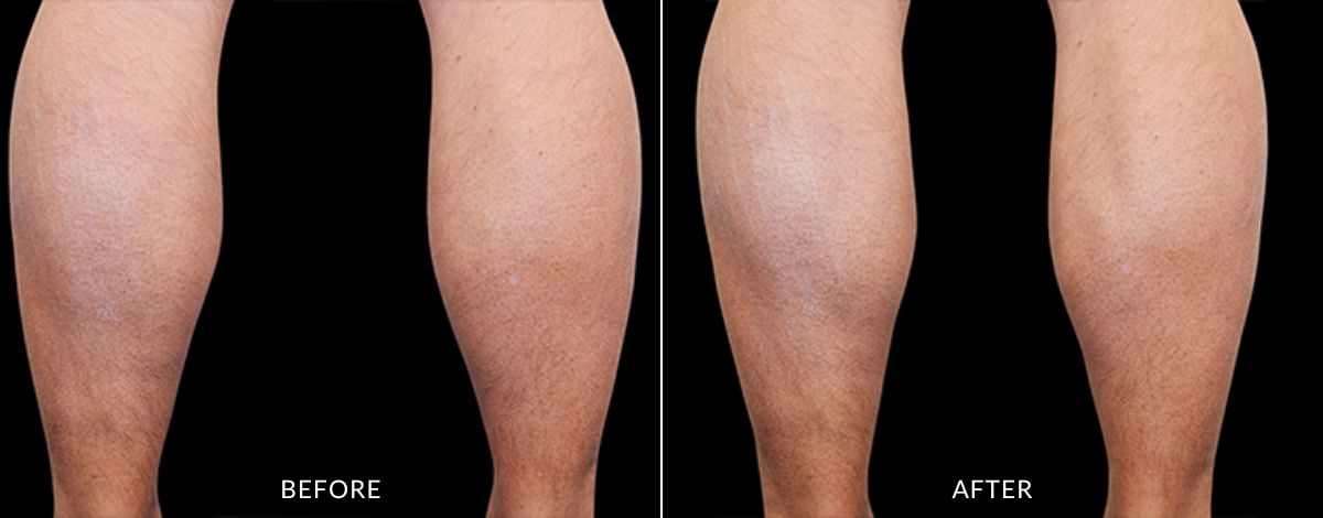 Comparison of a man's leg before and after treatment