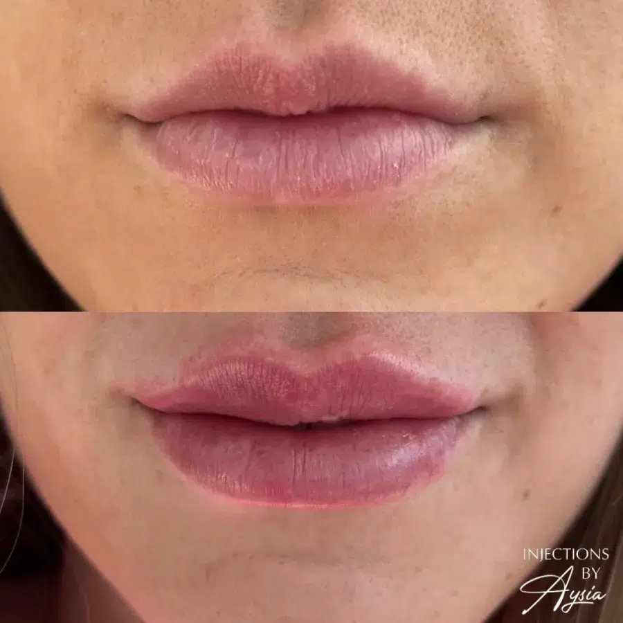 Lip Filler before and after 2 Haus of Aesthetics Salt Lake City, UT