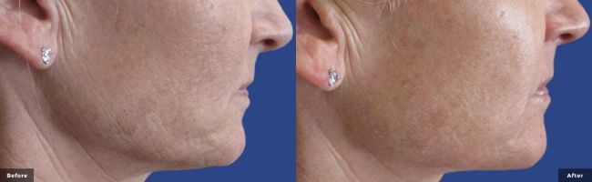 Agnes RF Microneedling before and after